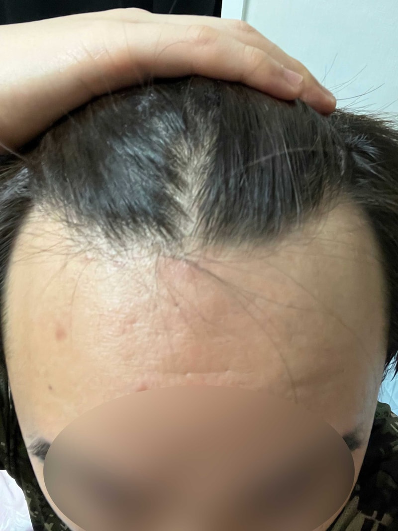 M자이마 헤어라인 모발이식수술 모원성형외과 1년 후기!!