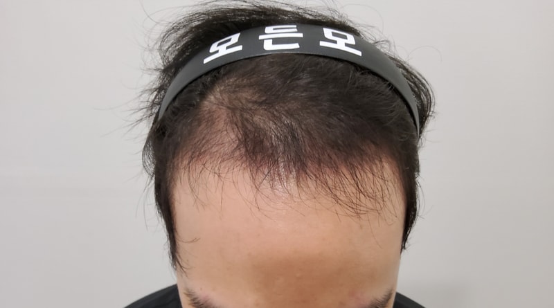 3. 수술후_3개월_1.jpg