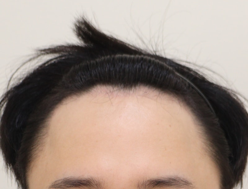 3. 수술후_3개월_1.JPG