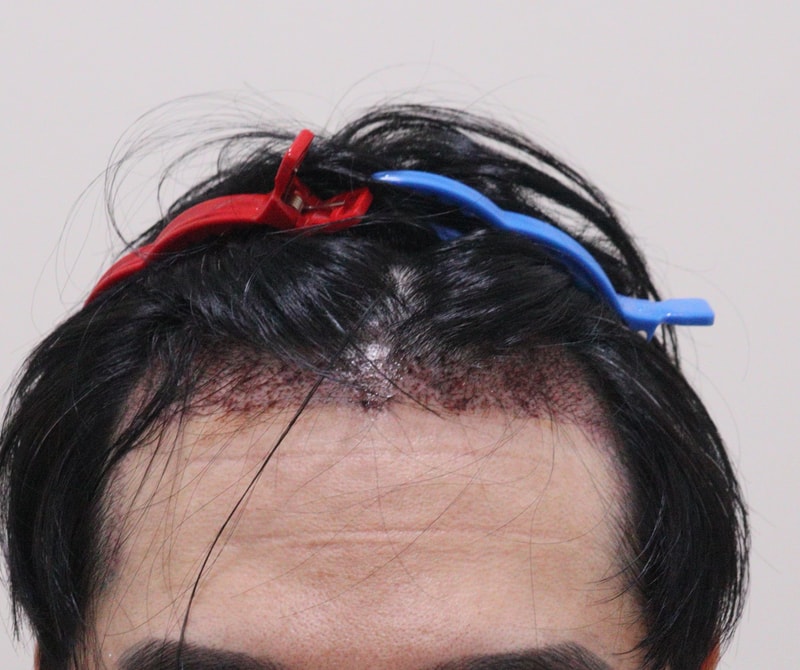 2. 수술후_1일_1.JPG