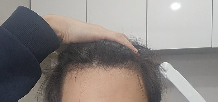 3. 오늘찍은 사진입니다 암흑기에 안빠진 머리들은 그대로 자라는게 너무 신기해요.jpg