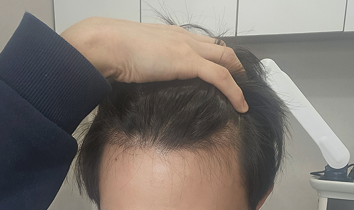 4. 셀카의 한계라 사진으로는 잘안보이는데 암흑기때 빠졌던 이식모가 조금씩 올라오고있습니다.jpg