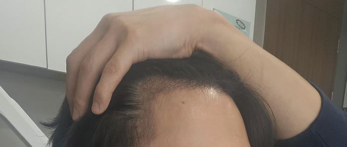 6. 우측 셀카..기분탓인지는 모르겠지만 측면부위가 더 빨리 올라오는것같아요.jpg