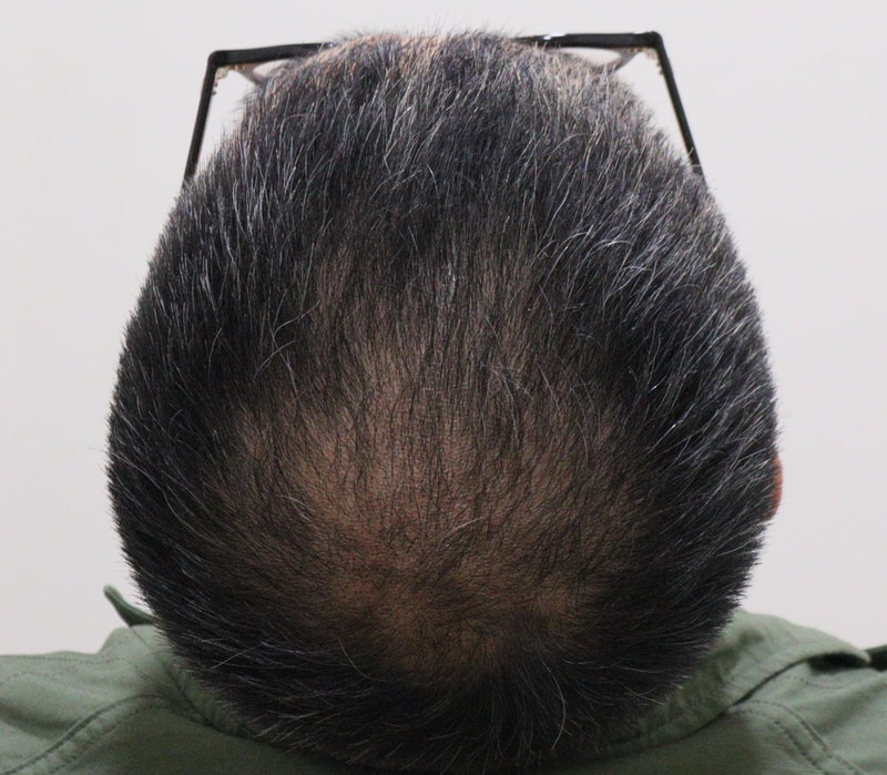3. 수술후_3개월_2.JPG