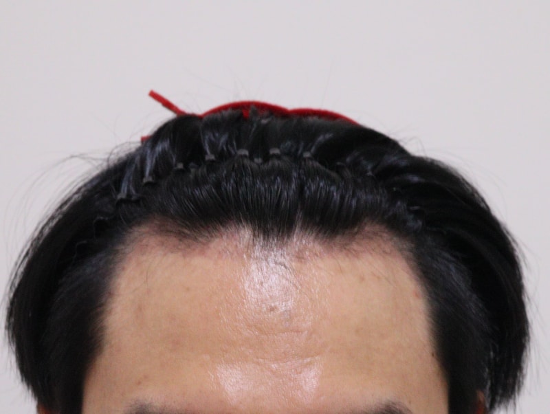 3. 수술후_3개월_1.JPG