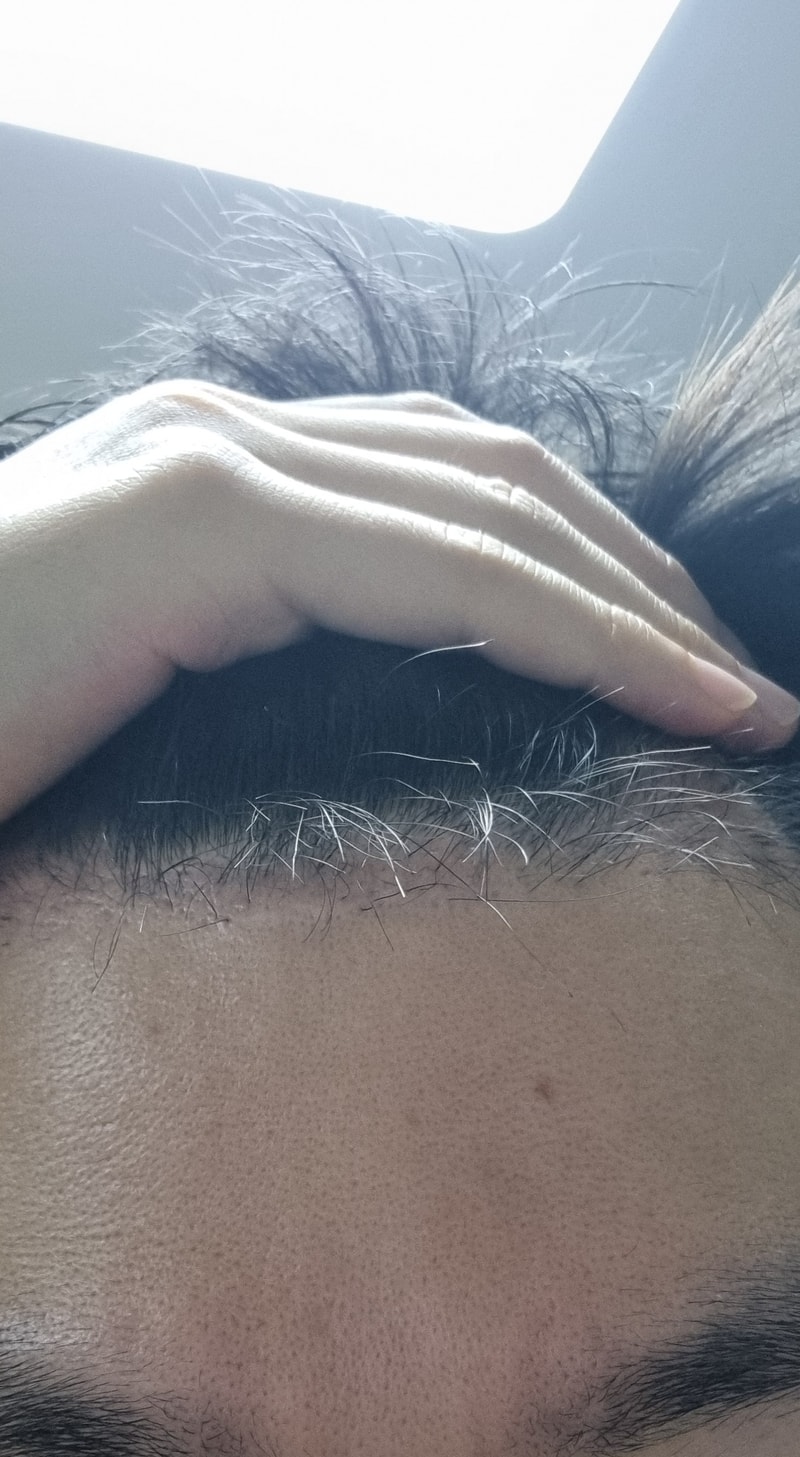 3. 수술후_3개월_셀카_1.jpg