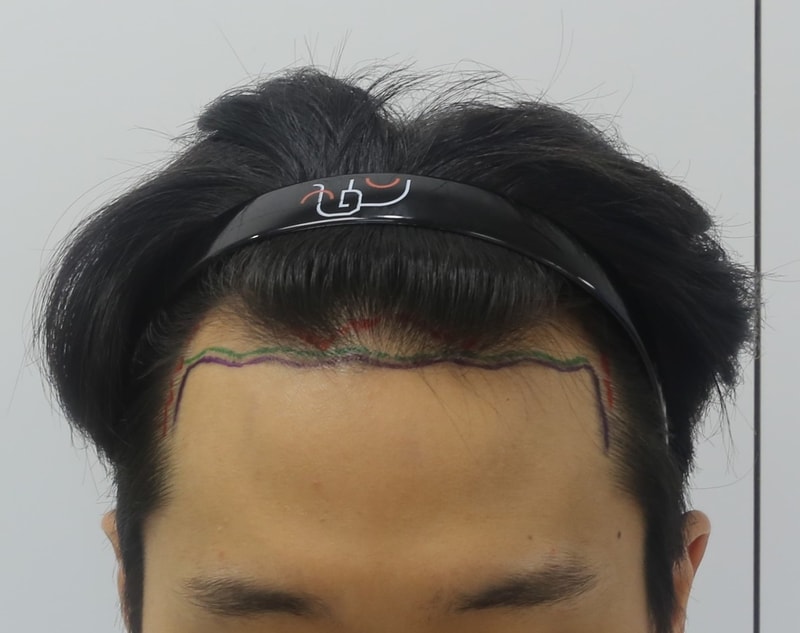 <압구정 맘모스 : 비절개 모발이식 수술 7개월 경과 후기>