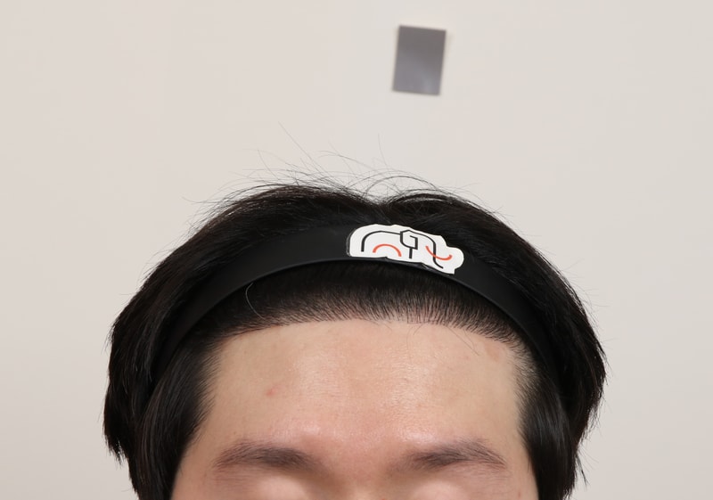 (7) 수술 9개월.jpg