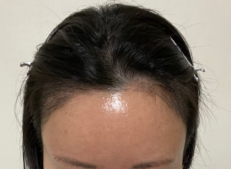 Director Lee Won Seok of MOJELIM Hair Transplant, I'm here for a month.