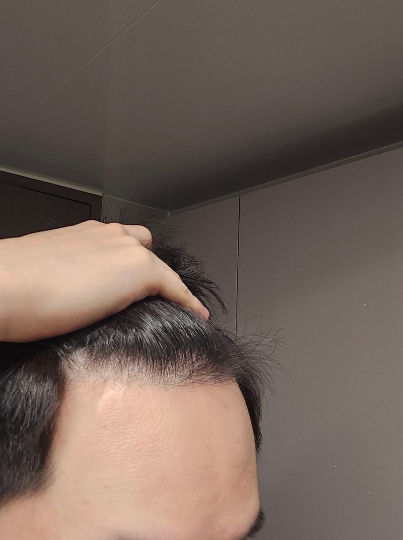 植毛手術から4か月目の体験談です。
