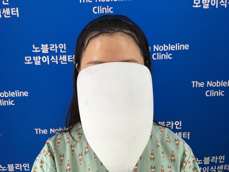 本当に最高！ まるで自然なヘアライン！