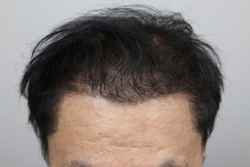 압구정모발이식_모나라피부과 (3).jpg