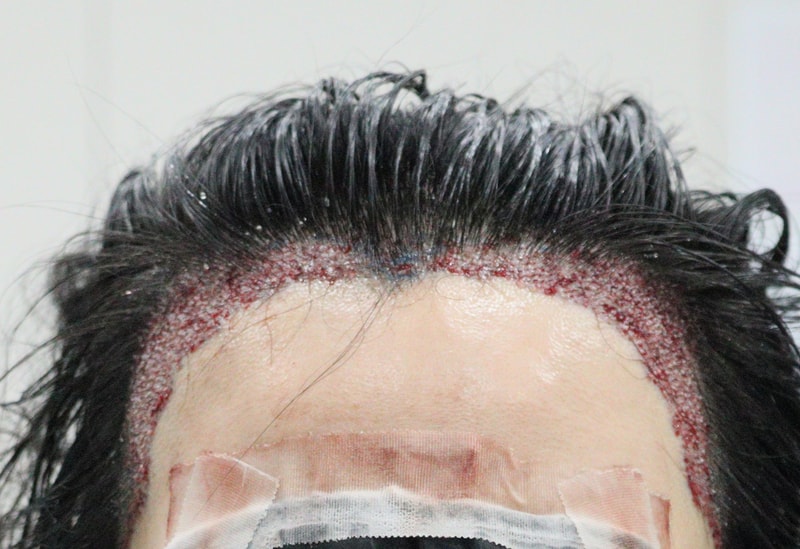 2. 수술후_당일_1.JPG