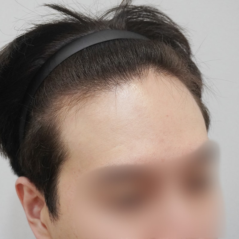 서진성형외과에서 받은 노컷 모발이식 2년차 후기!