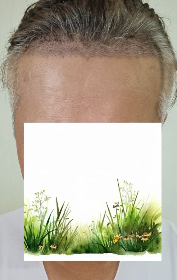 다나성형외과 비절개모발이식 3800모 21일차(암흑기를 만나다)