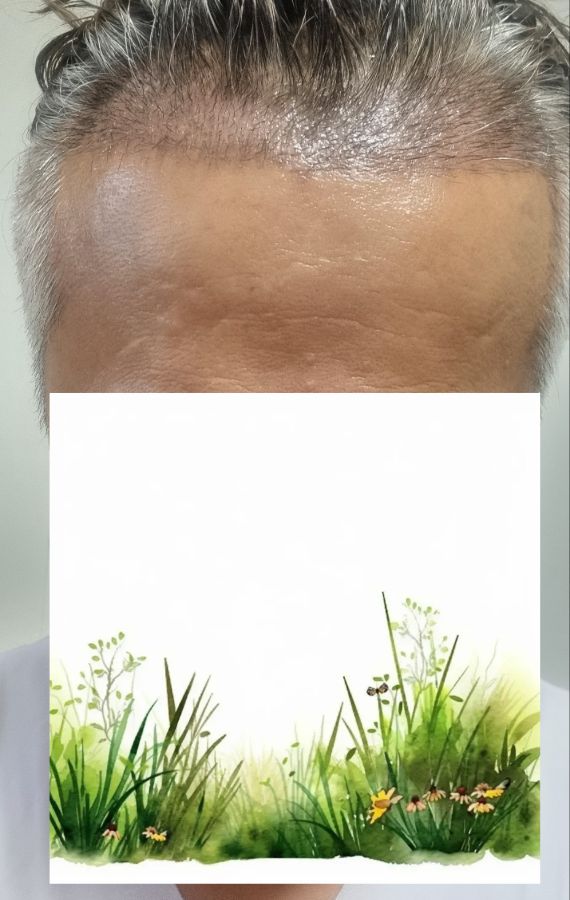 모발이식2주.jpg