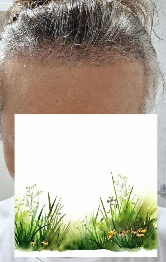 모발이식3주차.jpg