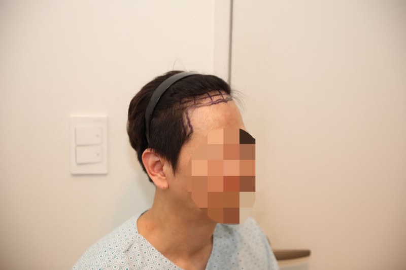 This is the review of the 9th month of NEWHAiR Hair Transplant.