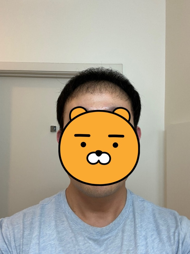 4.수술후_6개월_셀카_1.jpg