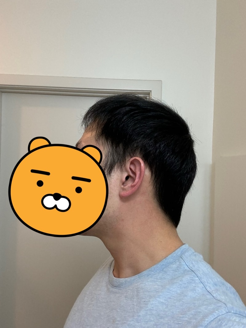 4.수술후_6개월_셀카_2.jpg