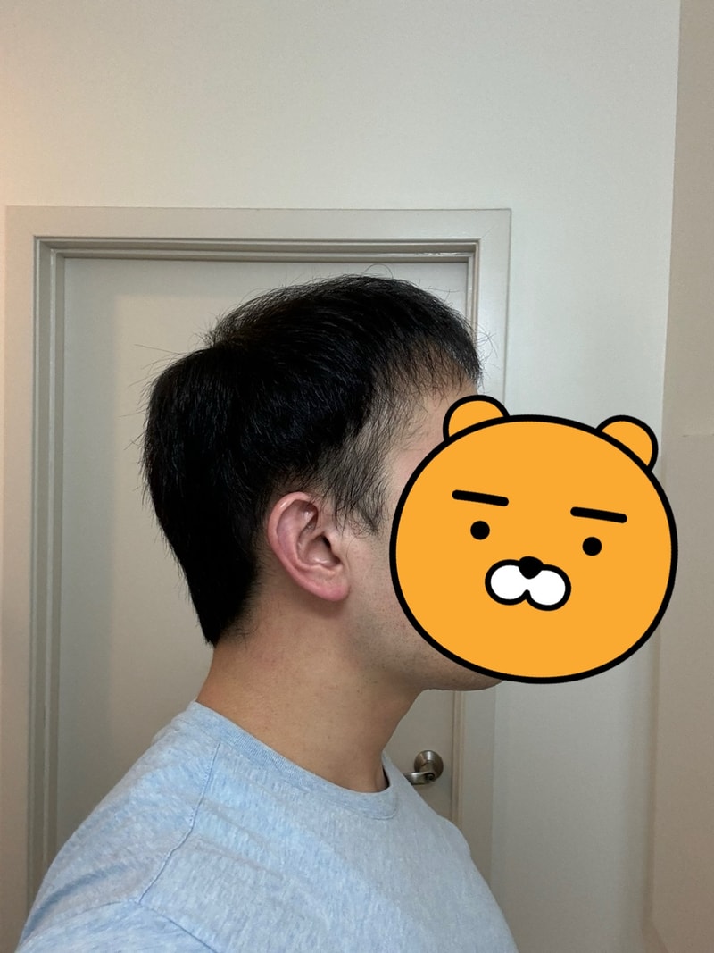 4.수술후_6개월_셀카_3.jpg