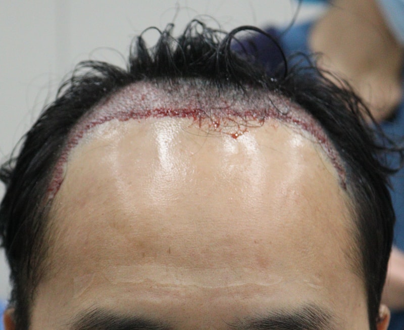 2. 수술후_당일_1.JPG