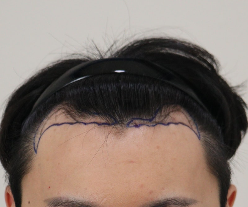 1. 수술전_1.JPG