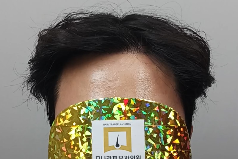 모나라피부과에서 모발이식하고 12개월 됐어요ㅎㅎㅎ