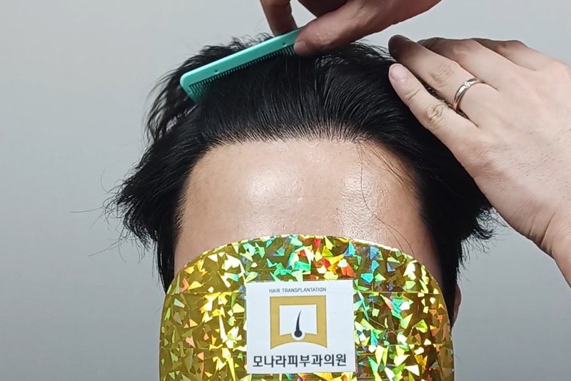 모나라피부과_모발이식1년 (5).jpg