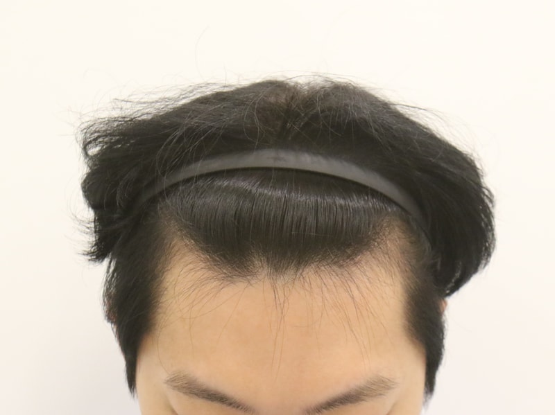 수술 전.JPG