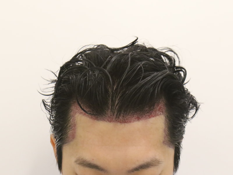 수술 후.JPG