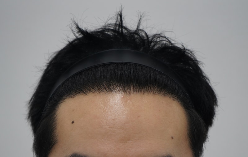 모아트의원 이식 1년후 후기