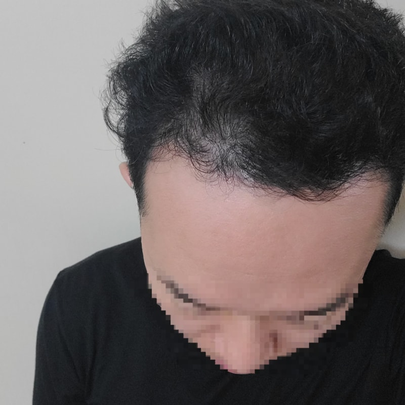 2500모낭 비절개 모발이식 4개월차 후기