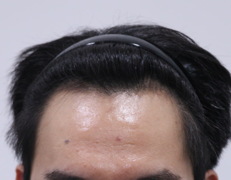 1. 수술전_1.JPG