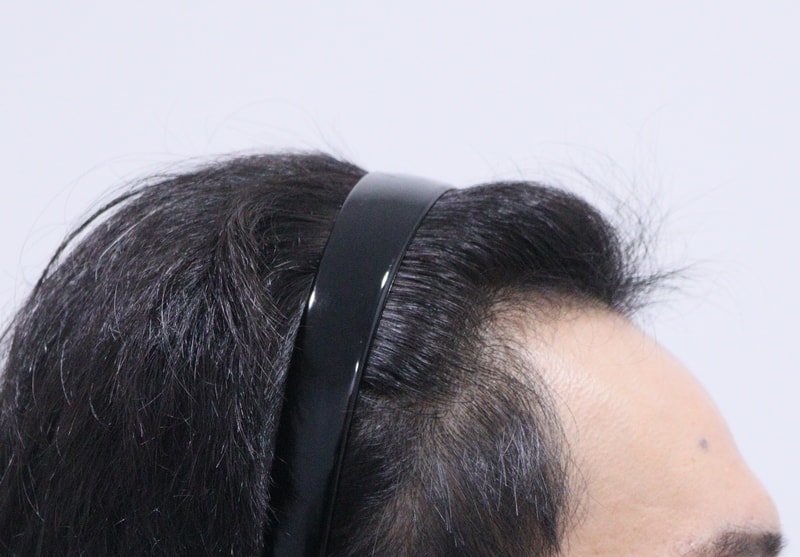 1. 수술전_3.JPG