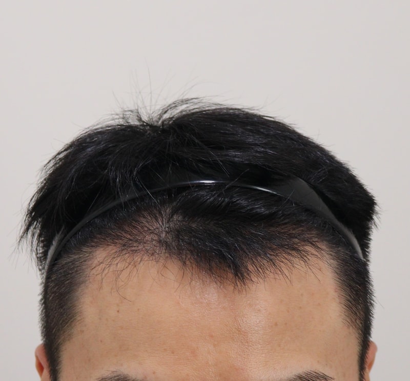 3. 수술후_6개월_1.JPG