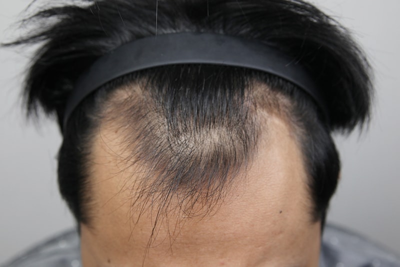 m, I got a scar Hair Transplant!!!