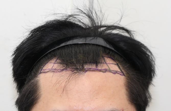 뉴헤어의원 김진오 원장님 모발이식 1500모낭(절개) 12개월차 후기