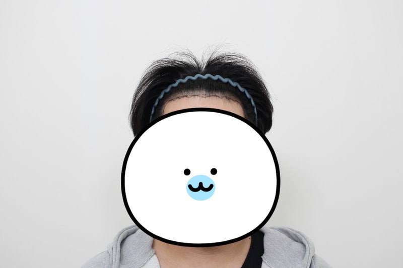 ★신사 모프로의원★ 모발이식 9일 차