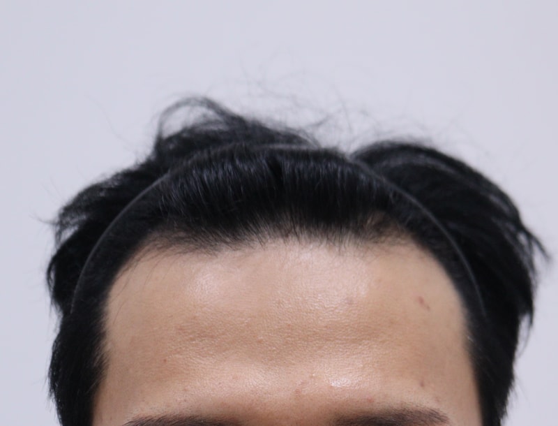 1. 수술전_1.JPG