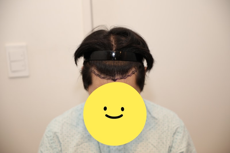 뉴헤어 9개월차 비절개 모발이식 후기 입니다(1600모낭)