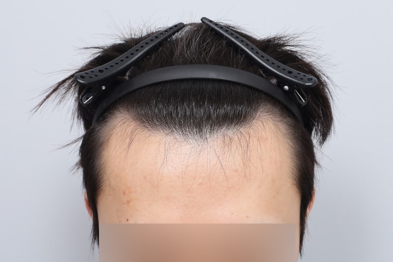 05년생 남자 비절개 모발이식 3000모 7개월차 모원성형외과