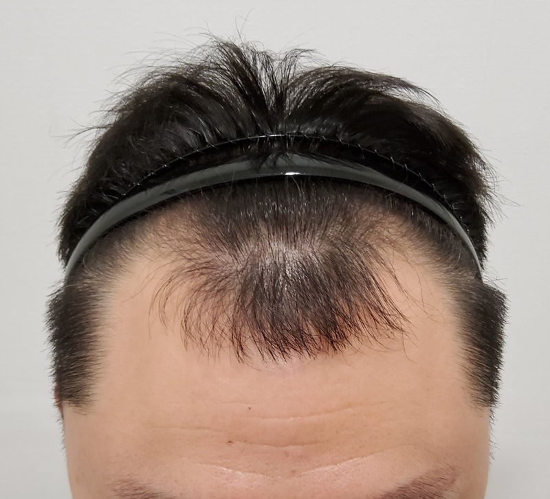 어제 오전에 모발이식 받았네요^^