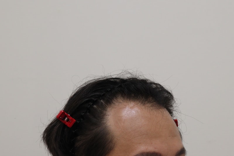 1. 수술전_3.JPG