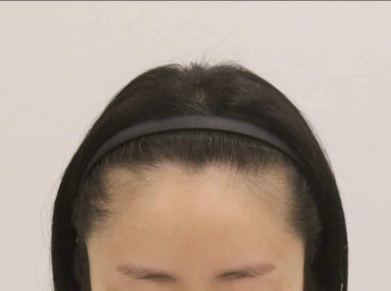 부산맘모스헤어라인의원 헤어라인교정 1년 최종 경과