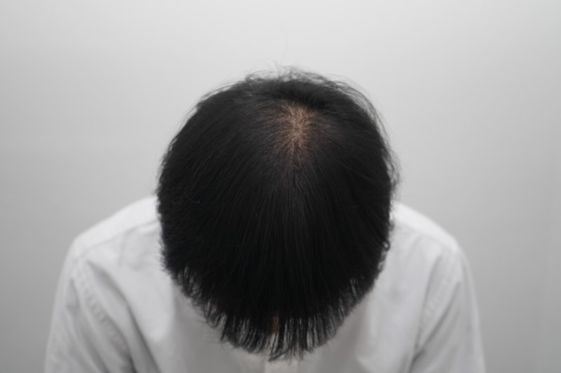 頭頂部体験談 第3週 モアットクリニック（植毛）
