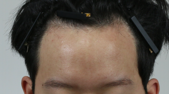 압구정 모우림의원 남성 모발이식 절개 1500모낭 후기
