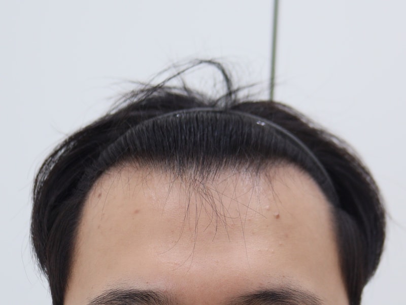 1. 수술전_1.JPG