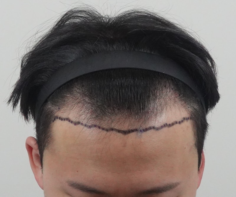 수술전.JPG