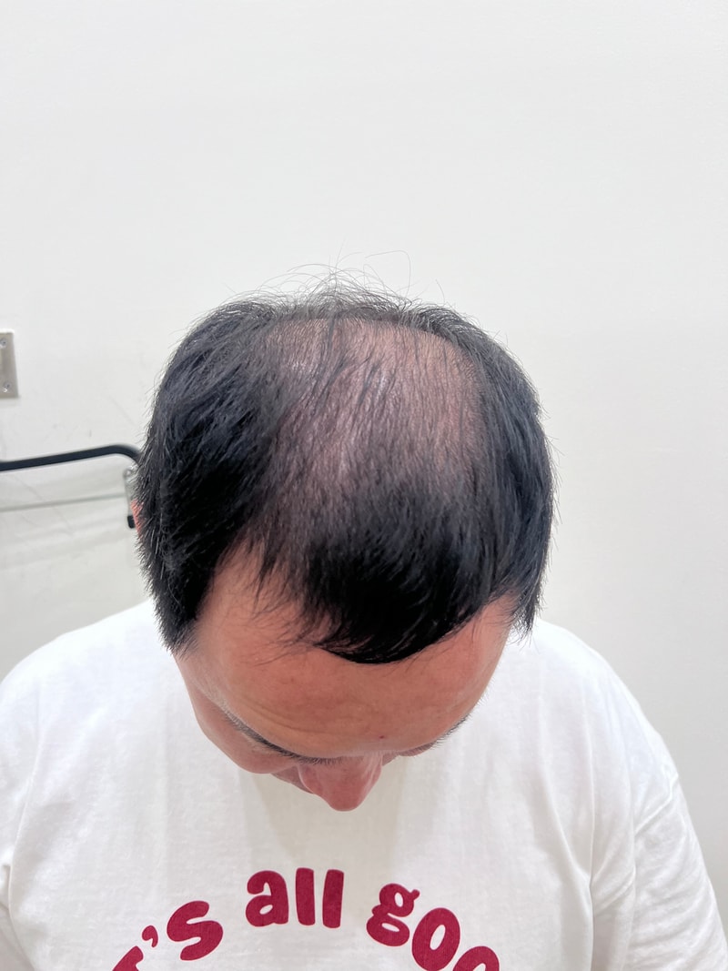 모발이식전.jpg